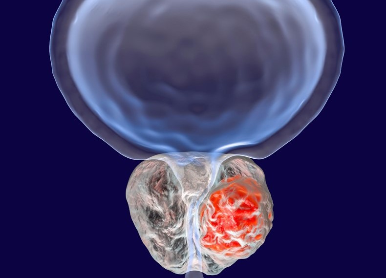 Lokal ileri evre prostat kanseri tedavi seçenekleri nelerdir? 1 lokal ileri evre prostat kanseri tedavi secenekleri nelerdir